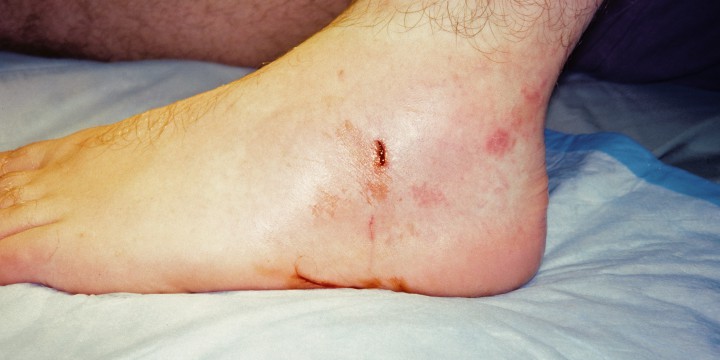 How To Treat Dog Bite Puncture Wounds On Humans How To Treat Dog Bite Puncture Wounds On Humans